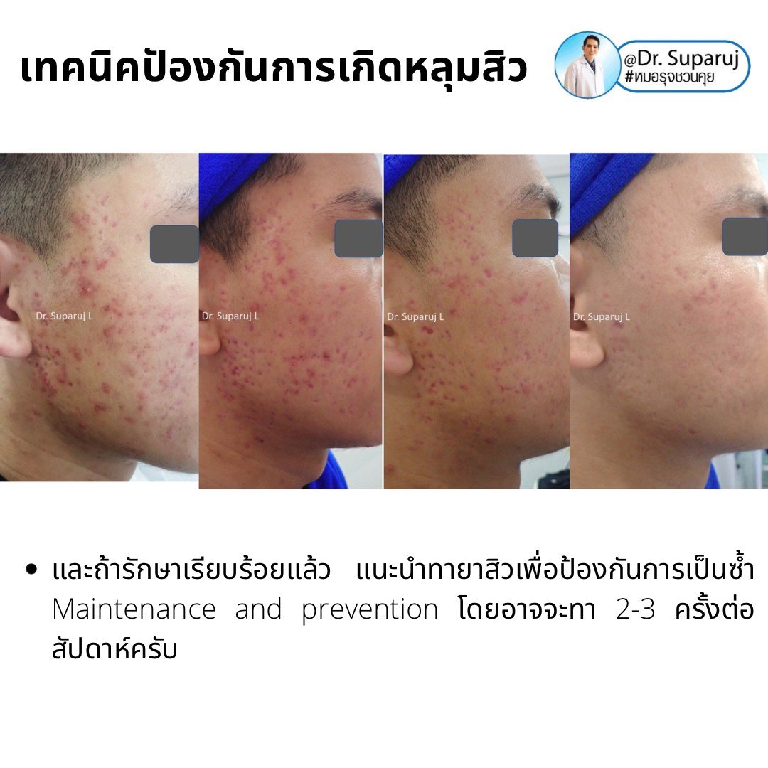 เป็นสิว + มีรอยดำจากสิว Acne dark spot ใช้ยา + สกินแคร์อะไร?จะได้ประโยชน์ดูแลทั้งสองอย่าง เป็นสิว + มีรอยดำจากสิว Acne dark spot ใช้ยา + สกินแคร์อะไร?จะได้ประโยชน์ดูแลทั้งสองอย่าง