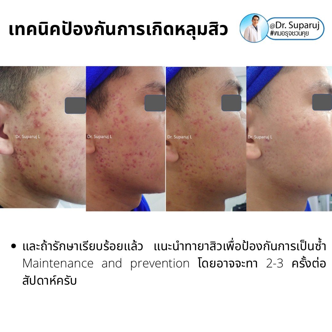 เป็นสิว + มีรอยดำจากสิว Acne dark spot ใช้ยา + สกินแคร์อะไร?จะได้ประโยชน์ดูแลทั้งสองอย่าง