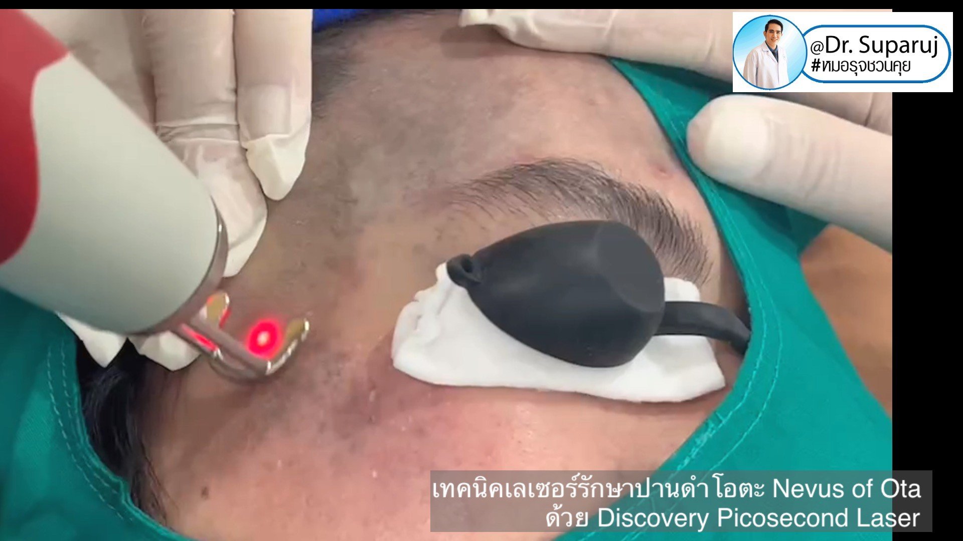 เทคนิคเลเซอร์รักษาปานดำโอตะ Nevus of Ota ด้วย Discovery Picosecond Laser เลเซอร์ปานดำ l หมอรุจชวนคุย เทคนิคเลเซอร์รักษาปานดำโอตะ Nevus of Ota ด้วย Discovery Picosecond Laser เลเซอร์ปานดำ l หมอรุจชวนคุย