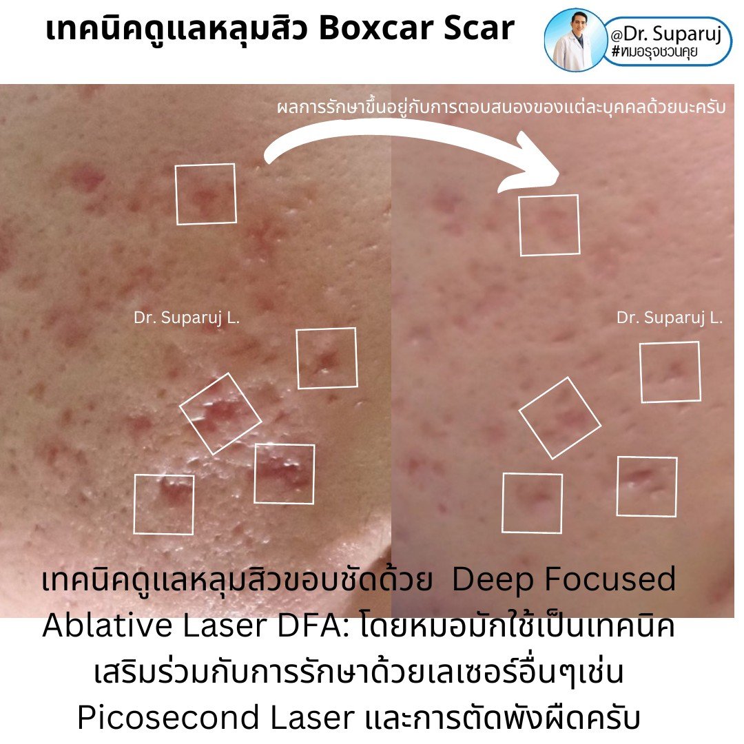 แนะนำเทคนิคดูแลหลุมสิว: เทคนิค Deep Focused Ablative Laser (DFA) ดูแลหลุมสิวลึกขอบชัดพังผืดหนา Boxcar Scar และหลุมสิวลักษณะเส้นยาว Linear scar แนะนำเทคนิคดูแลหลุมสิว: เทคนิค Deep Focused Ablative Laser (DFA) ดูแลหลุมสิวลึกขอบชัดพังผืดหนา Boxcar Scar และหลุมสิวลักษณะเส้นยาว Linear scar
