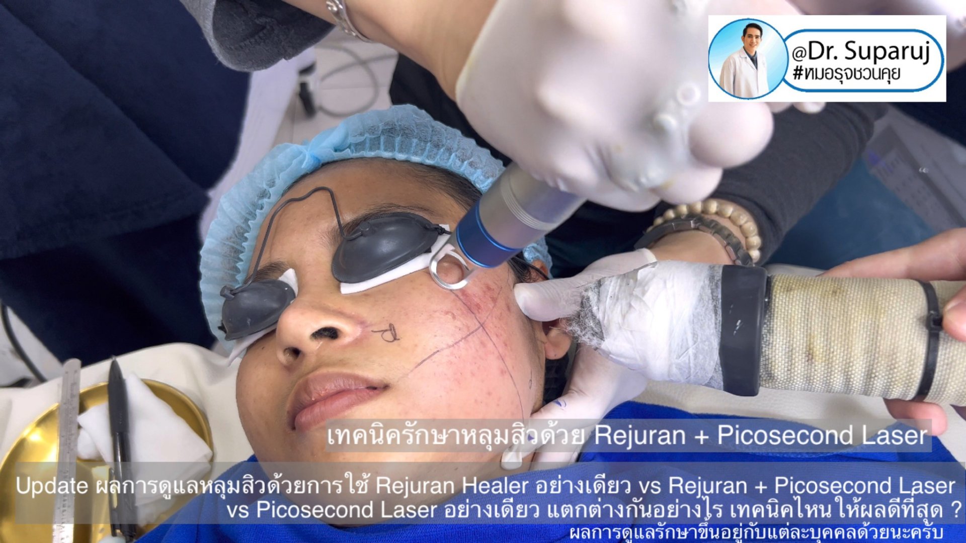 Update ผลการรักษาหลุมสิวด้วยเทคนิค Rejuran Healer อย่างเดียว vs Rejuran + Picosecond Laser vs Picosecond Laser อย่างเดียว แตกต่างกันอย่างไร เทคนิคไหนให้ผลดีที่สุด ? Update ผลการรักษาหลุมสิวด้วยเทคนิค Rejuran Healer อย่างเดียว vs Rejuran + Picosecond Laser vs Picosecond Laser อย่างเดียว แตกต่างกันอย่างไร เทคนิคไหนให้ผลดีที่สุด ?