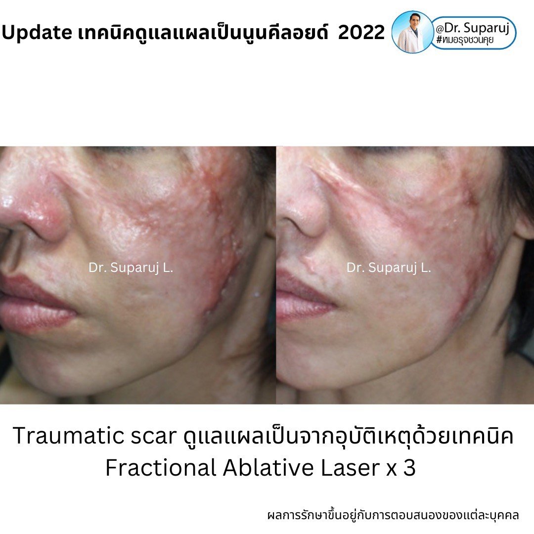 แผลเป็นนูนคีลอยคีลอยด์สามารถรักษาด้วยโดยวิธีผ่าตัดออกได้ไหม ? แผลเป็นนูนคีลอยคีลอยด์สามารถรักษาด้วยโดยวิธีผ่าตัดออกได้ไหม ?