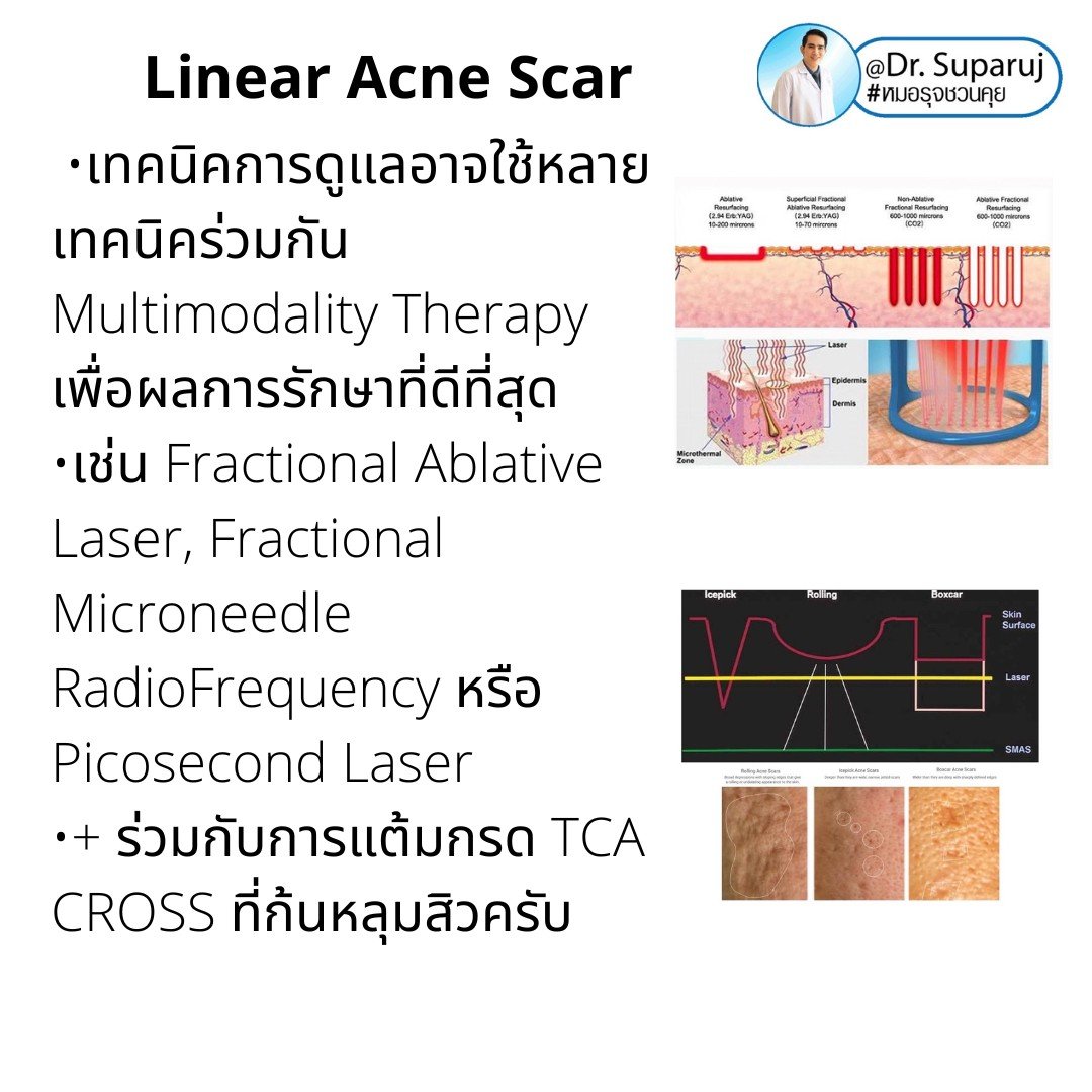 เทคนิคประเมินความรุนแรงพังผืดหลุมสิว Acne Scar Fibrosis Assessment : เทคนิคดึงยืดผิว Mannual Strechching (ง่ายๆ ประเมินได้ด้วยตัวเองครับ )  เทคนิคประเมินความรุนแรงพังผืดหลุมสิว Acne Scar Fibrosis Assessment : เทคนิคดึงยืดผิว Mannual Strechching (ง่ายๆ ประเมินได้ด้วยตัวเองครับ )