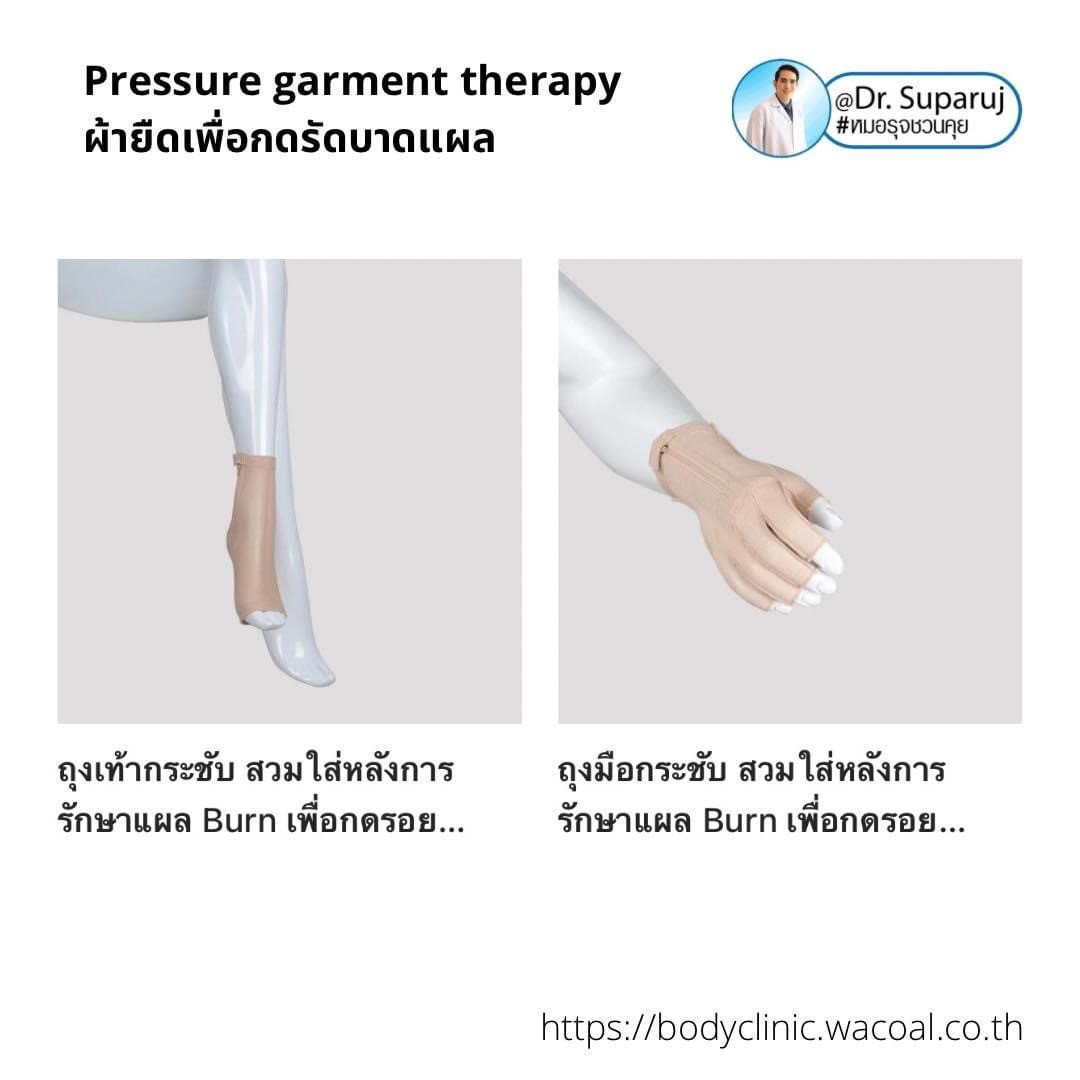 แนะนำเทคนิคดูแลแผลเป็นนูนคีลอยด์: ป้องกันการเป็นซ้ำของแผลเป็นนูนคีลอยด์ด้วยการใช้ Pressure garment therapy ผ้ายืดเพื่อกดรัดบาดแผล แนะนำเทคนิคดูแลแผลเป็นนูนคีลอยด์: ป้องกันการเป็นซ้ำของแผลเป็นนูนคีลอยด์ด้วยการใช้ Pressure garment therapy ผ้ายืดเพื่อกดรัดบาดแผล