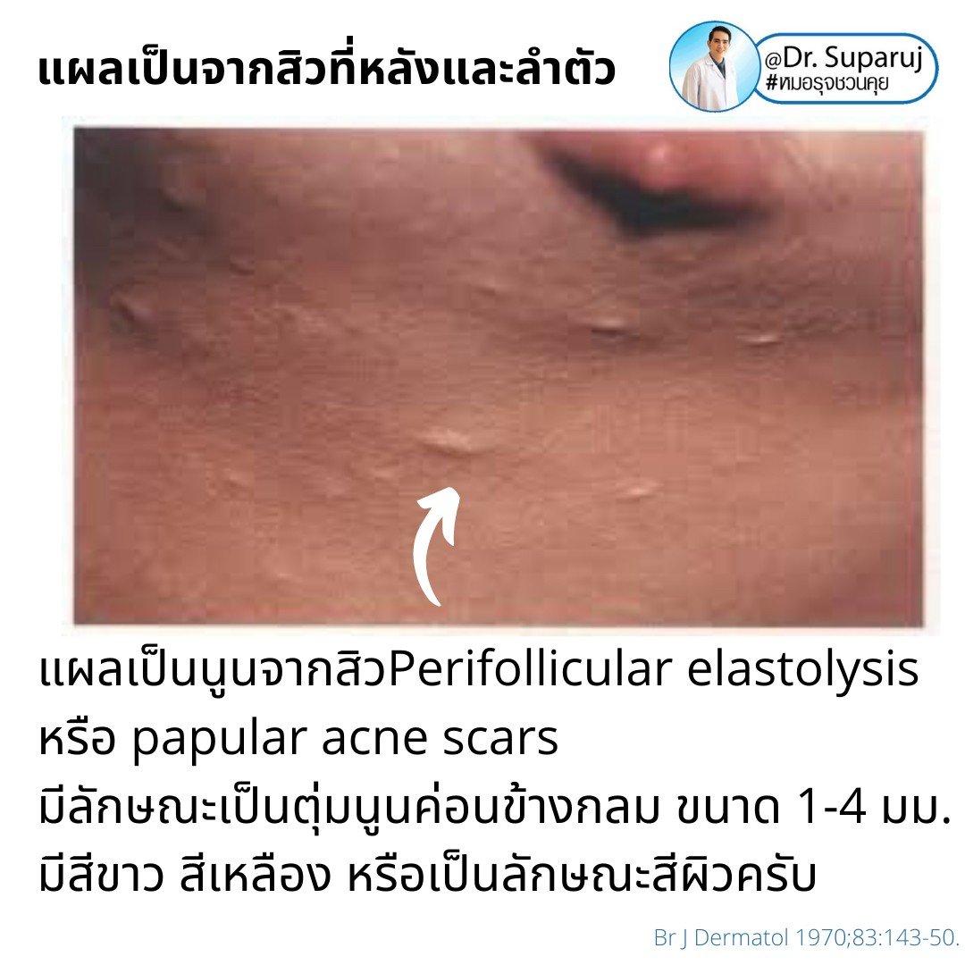 การรักษาเสริม: การรักษาเสริมด้วยหัตถการต่างๆ การรักษาเสริม: การรักษาเสริมด้วยหัตถการต่างๆ