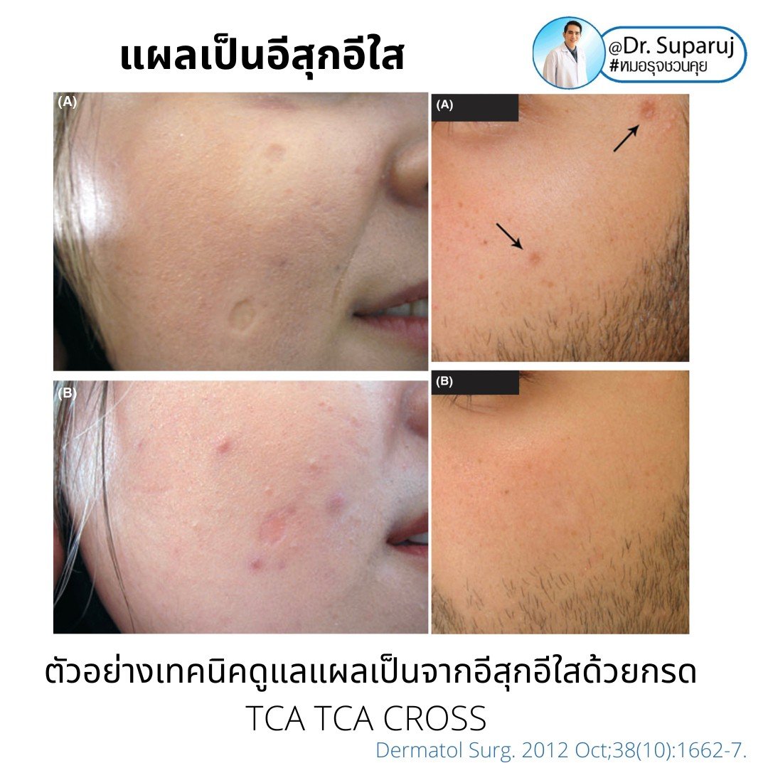 แผลเป็นยุบตัวจากอีสุกอีใส Chicken pox scars ดูแลได้อย่างไร ? แผลเป็นยุบตัวจากอีสุกอีใส Chicken pox scars ดูแลได้อย่างไร ?