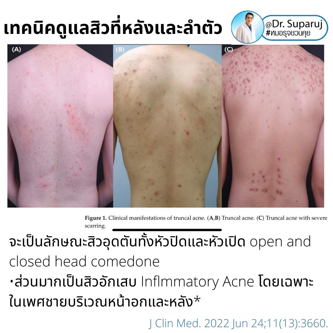 สิวที่หลัง และลำตัว Truncal & Body Acne เกิดจากอะไรและดูแลรักษาได้อย่างไร ? (Update + รีวิว)