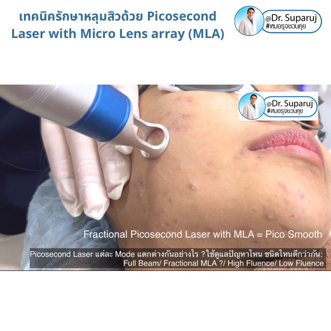แนะนำเทคนิคดูแลหลุมสิว: Picosecond Laser แต่ละ Mode แตกต่างกันอย่างไร ? ใช้ดูแลปัญหาไหน ชนิดไหนดีกว่ากัน: Full Beam/ Fractional MLA ?/ High Fluence/ Low Fluence แนะนำเทคนิคดูแลหลุมสิว: Picosecond Laser แต่ละ Mode แตกต่างกันอย่างไร ? ใช้ดูแลปัญหาไหน ชนิดไหนดีกว่ากัน: Full Beam/ Fractional MLA ?/ High Fluence/ Low Fluence