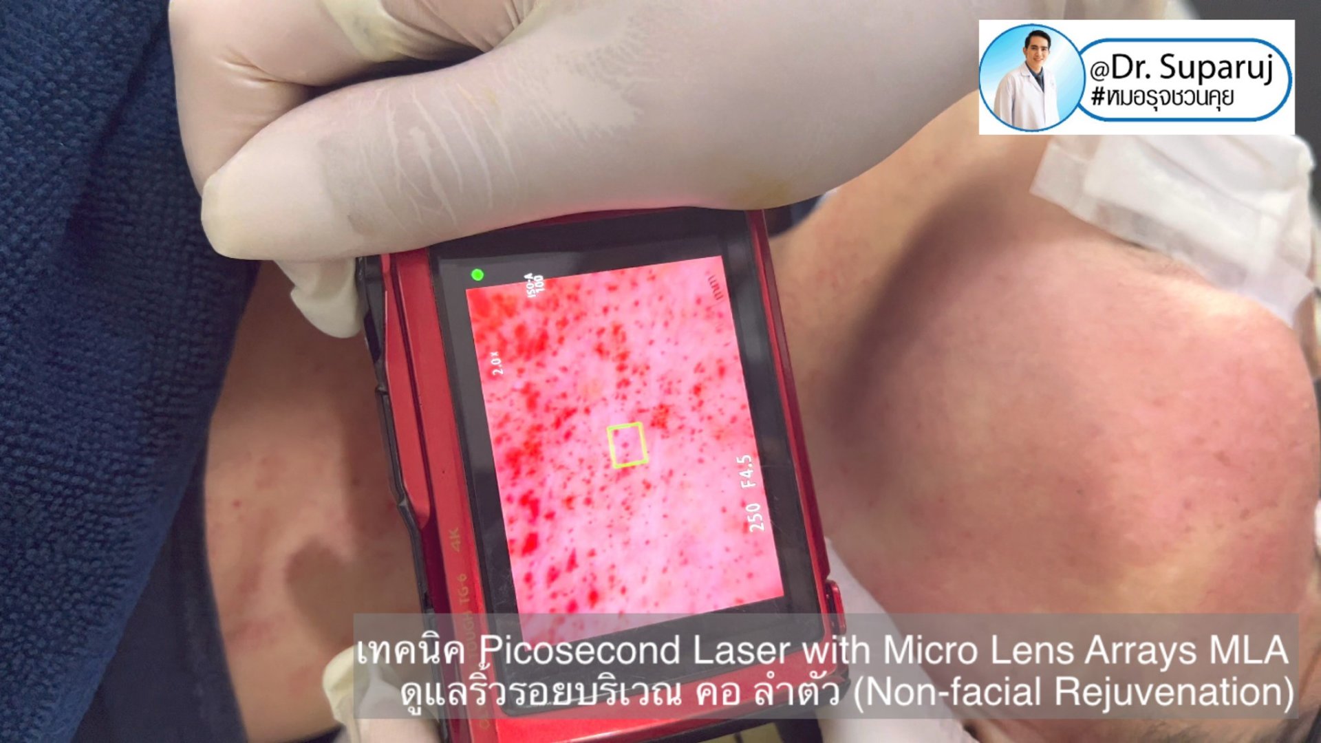 แนะนำ เทคนิคการใช้เลเซอร์ Picosecond Laser with Micro Lens Arrays MLA เพื่อดูแลริ้วรอยบริเวณ คอ ลำตัว (Non-facial rejuvenation) แนะนำ เทคนิคการใช้เลเซอร์ Picosecond Laser with Micro Lens Arrays MLA เพื่อดูแลริ้วรอยบริเวณ คอ ลำตัว (Non-facial rejuvenation)