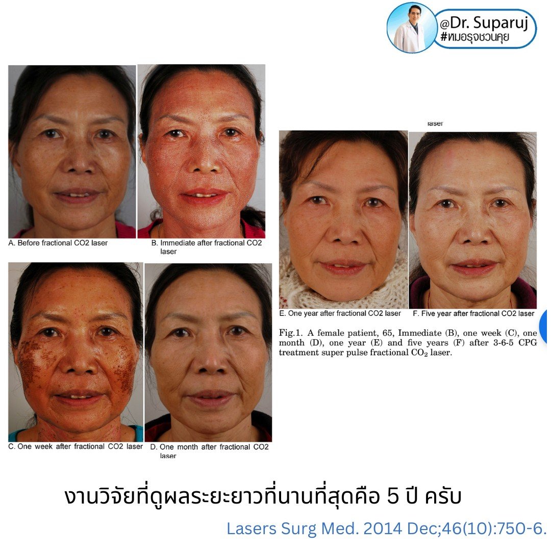 Q: หลังรักษาหลุมสิวด้วยเลเซอร์หรือเทคนิคต่างๆ หลังจากรักษาเรียบร้อยแล้ว จะมีโอกาสกลับมายุบตัว หรือหลุมสิวจะกลับมาแบบเดิมไหม? Q: หลังรักษาหลุมสิวด้วยเลเซอร์หรือเทคนิคต่างๆ หลังจากรักษาเรียบร้อยแล้ว จะมีโอกาสกลับมายุบตัว หรือหลุมสิวจะกลับมาแบบเดิมไหม?