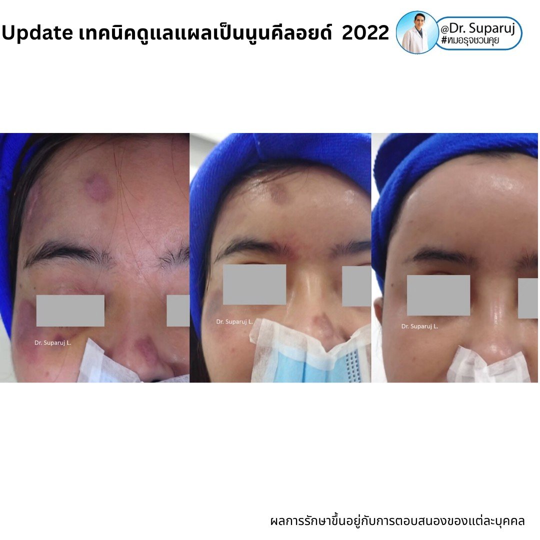 Update เทคนิคดูแลแผลเป็นนูนคีลอยด์ 2022 Update เทคนิคดูแลแผลเป็นนูนคีลอยด์ 2022