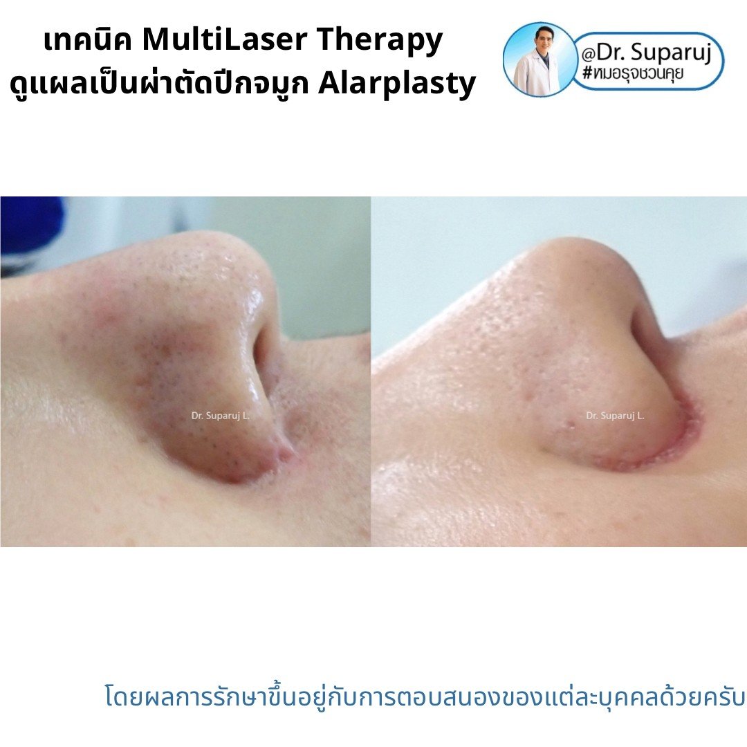 แนะนำเทคนิคดูแลแผลเป็นจากการผ่าตัด: ดูแลแผลเป็นนูนจากการผ่าตัดปีกจมูก Alarplasty ด้วยเทคนิค MultiLaser Therapy: Picosecond Laser + Gold Toning + Fractional Laser + Injection แนะนำเทคนิคดูแลแผลเป็นจากการผ่าตัด: ดูแลแผลเป็นนูนจากการผ่าตัดปีกจมูก Alarplasty ด้วยเทคนิค MultiLaser Therapy: Picosecond Laser + Gold Toning + Fractional Laser + Injection