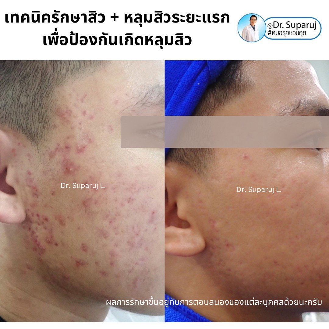 แนะนำเทคนิคดูแลรักษาสิวและหลุมสิว: ดูแลรอยแดงจากสิวและแผลเป็นยุบตัวจากสิว Acne + Macular acne erythema + Atrophic acne scar ดูแลด้วย Picosecond Laser + Healite + Medication แนะนำเทคนิคดูแลรักษาสิวและหลุมสิว: ดูแลรอยแดงจากสิวและแผลเป็นยุบตัวจากสิว Acne + Macular acne erythema + Atrophic acne scar ดูแลด้วย Picosecond Laser + Healite + Medication