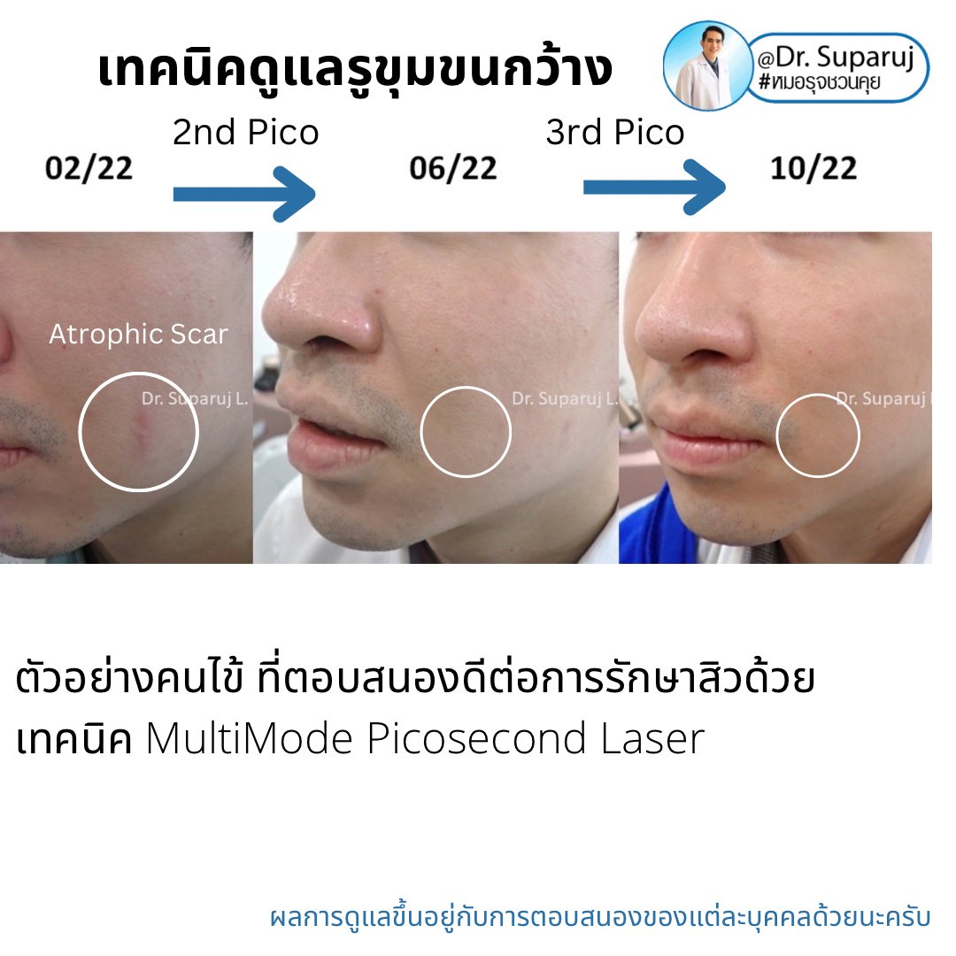 หลุมสิวจำเป็นต้องรักษากี่ครั้ง? ทำไมต้องรักษาหลายครั้ง ? หลุมสิวจำเป็นต้องรักษากี่ครั้ง? ทำไมต้องรักษาหลายครั้ง ?