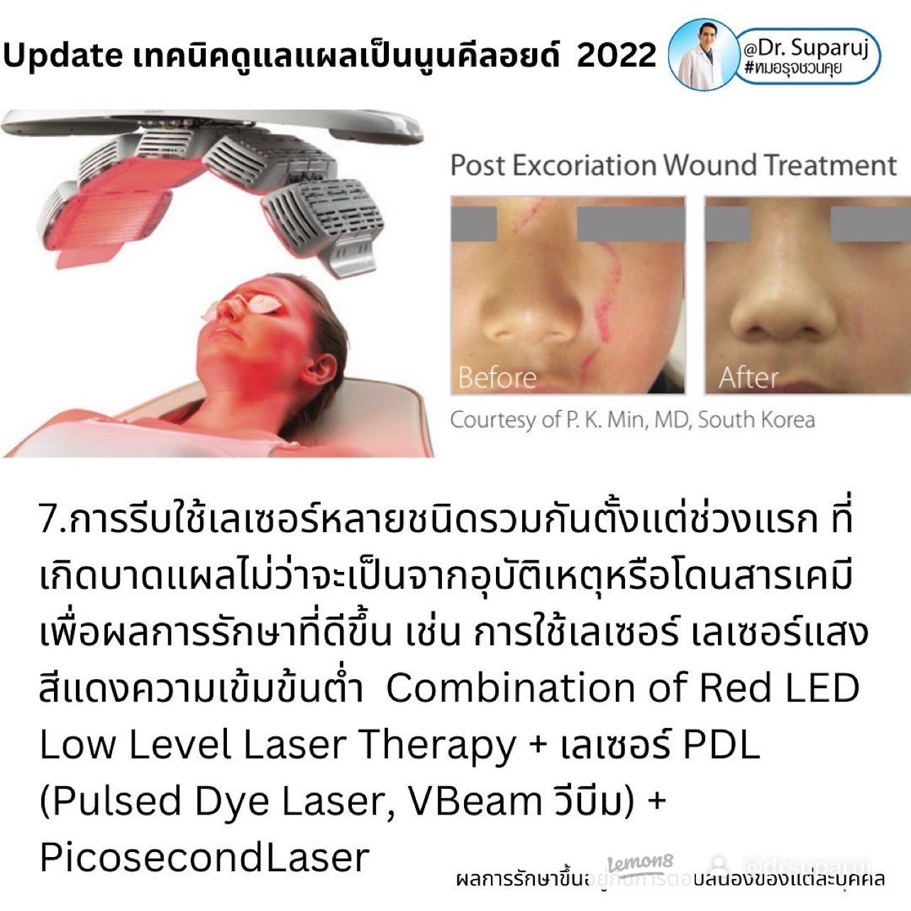 แผลเป็นนูนคีลอยคีลอยด์สามารถรักษาด้วยโดยวิธีผ่าตัดออกได้ไหม ? แผลเป็นนูนคีลอยคีลอยด์สามารถรักษาด้วยโดยวิธีผ่าตัดออกได้ไหม ?