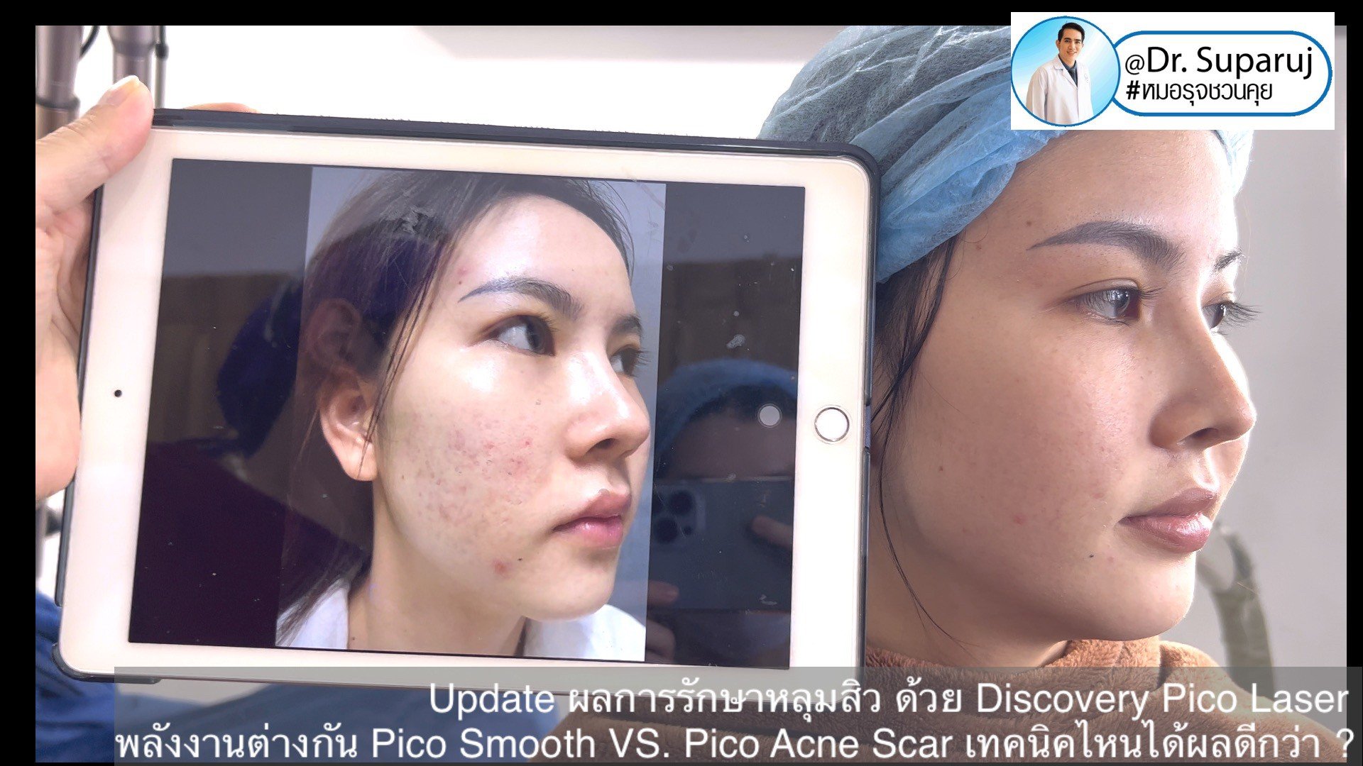  Update ผลการรักษาหลุมสิว ด้วย Discovery Pico Laser พลังงานต่างกัน Pico Smooth (Moderate Fluence) VS. Pico Acne Scar (High Fluence)เทคนิคไหนได้ผลดีกว่า ?