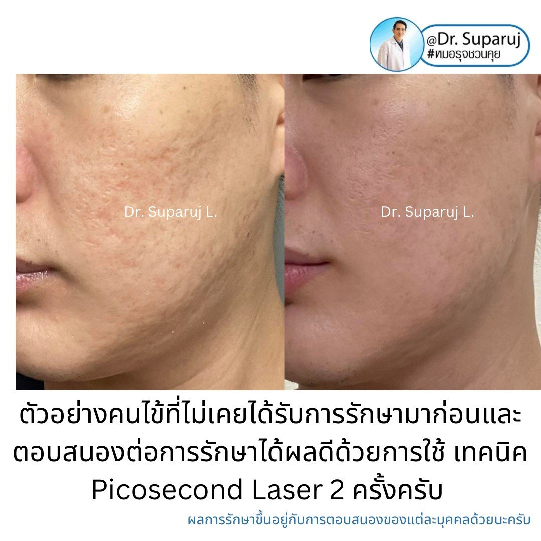 หลุมสิวจำเป็นต้องรักษากี่ครั้ง? ทำไมต้องรักษาหลายครั้ง ? หลุมสิวจำเป็นต้องรักษากี่ครั้ง? ทำไมต้องรักษาหลายครั้ง ?