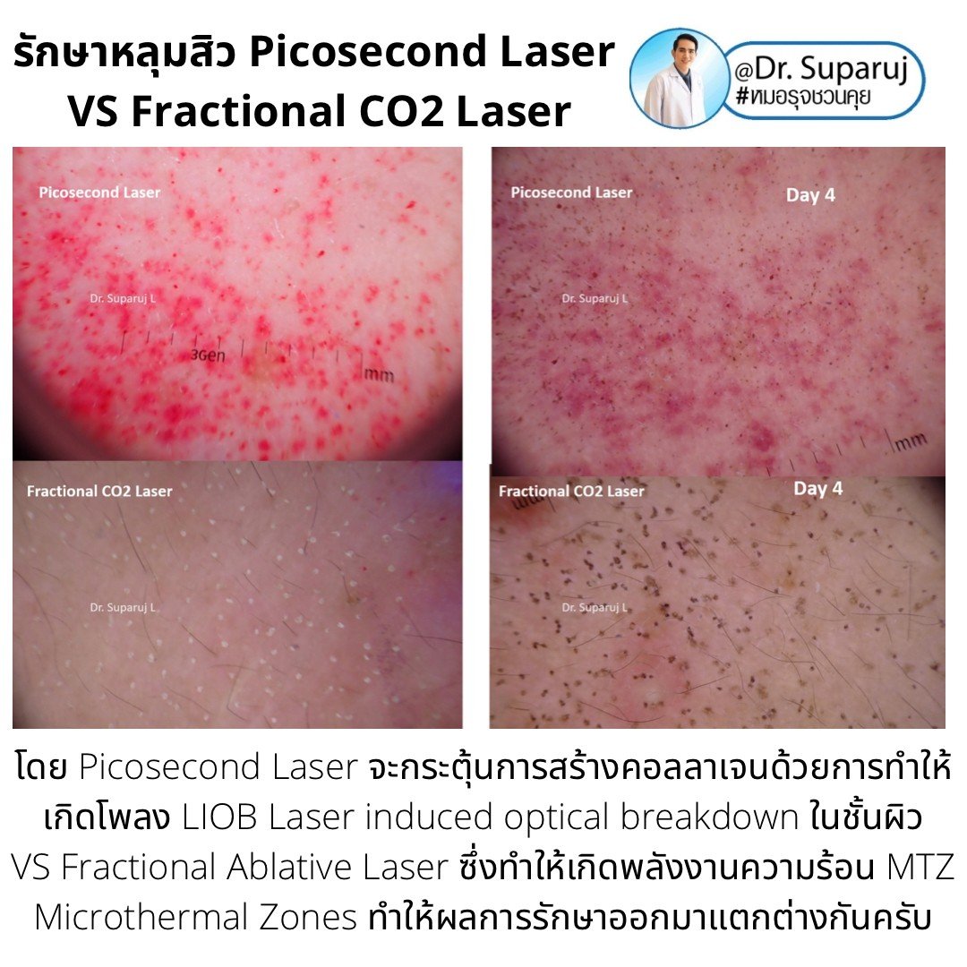 Update ผลการรักษาหลุมสิวด้วยเลเซอร์ Picosecond Laser VS Fractional CO2 Laser ต่างกันอย่างไร? เลเซอร์ชนิดไหนให้ผลดีกว่า?