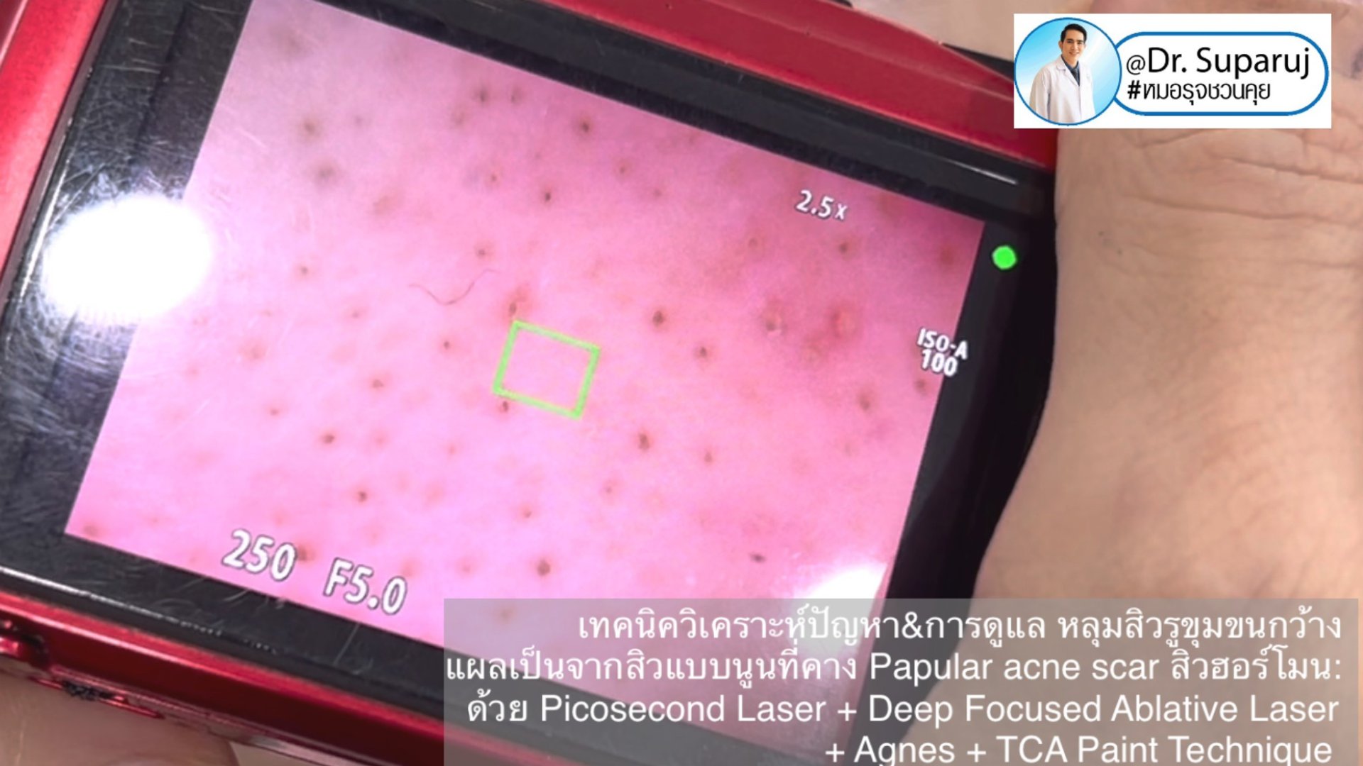 เทคนิควิเคราะห์ปัญหา & รักษาหลุมสิว รูขุมขนกว้าง แผลเป็นจากสิวแบบนูน Papular acne scar สิวฮอร์โมน: ด้วย Picosecond Laser + Deep Focused Ablative Laser + Agnes + TCA Paint Technique เทคนิควิเคราะห์ปัญหา & รักษาหลุมสิว รูขุมขนกว้าง แผลเป็นจากสิวแบบนูน Papular acne scar สิวฮอร์โมน: ด้วย Picosecond Laser + Deep Focused Ablative Laser + Agnes + TCA Paint Technique