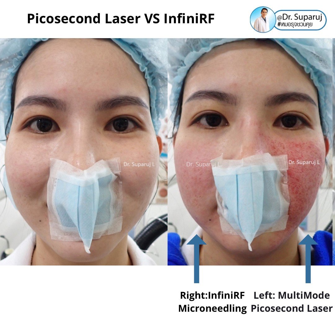 Update ผลการรักษาหลุมสิวด้วย Picosecond Laser VS InfiniRF Microneedle แตกต่างกันอย่างไร อันไหนมีประสิทธิภาพดีกว่า ? Update ผลการรักษาหลุมสิวด้วย Picosecond Laser VS InfiniRF Microneedle แตกต่างกันอย่างไร อันไหนมีประสิทธิภาพดีกว่า ?