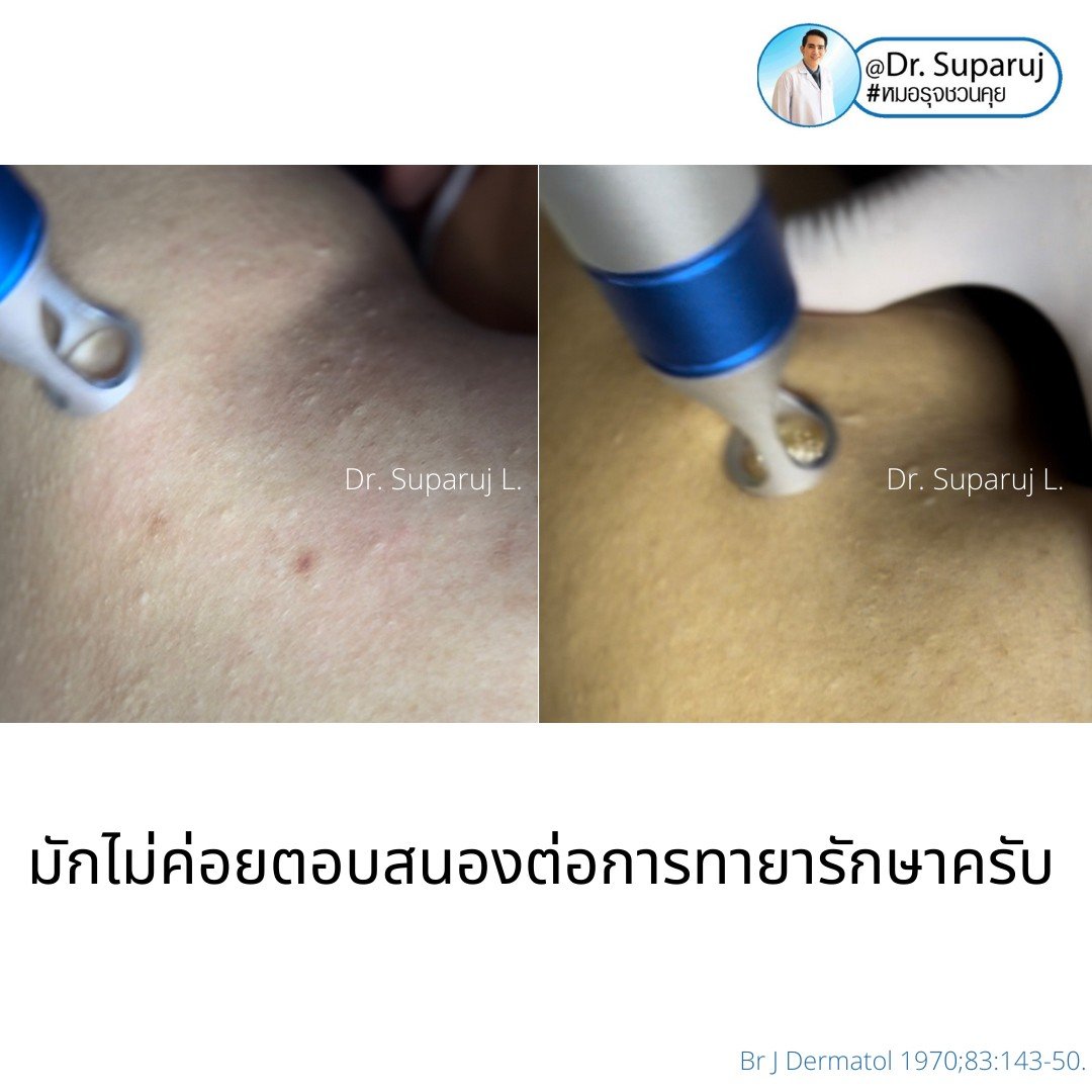 การรักษาเสริม: การรักษาเสริมด้วยหัตถการต่างๆ