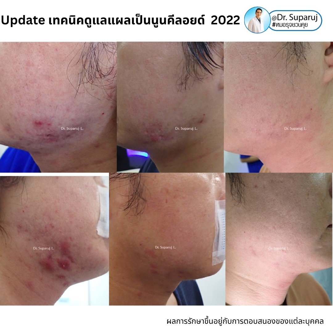 Update เทคนิคดูแลแผลเป็นนูนคีลอยด์ 2022 Update เทคนิคดูแลแผลเป็นนูนคีลอยด์ 2022