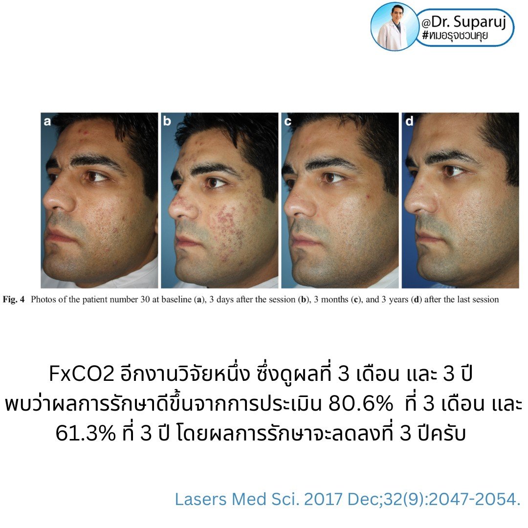 Q: หลังรักษาหลุมสิวด้วยเลเซอร์หรือเทคนิคต่างๆ หลังจากรักษาเรียบร้อยแล้ว จะมีโอกาสกลับมายุบตัว หรือหลุมสิวจะกลับมาแบบเดิมไหม? Q: หลังรักษาหลุมสิวด้วยเลเซอร์หรือเทคนิคต่างๆ หลังจากรักษาเรียบร้อยแล้ว จะมีโอกาสกลับมายุบตัว หรือหลุมสิวจะกลับมาแบบเดิมไหม?