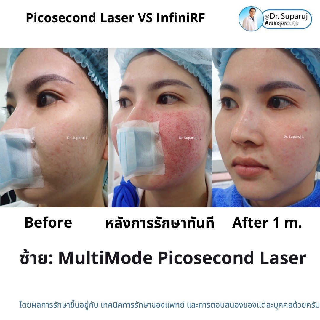 Update ผลการรักษาหลุมสิวด้วย Picosecond Laser VS InfiniRF Microneedle แตกต่างกันอย่างไร อันไหนมีประสิทธิภาพดีกว่า ?