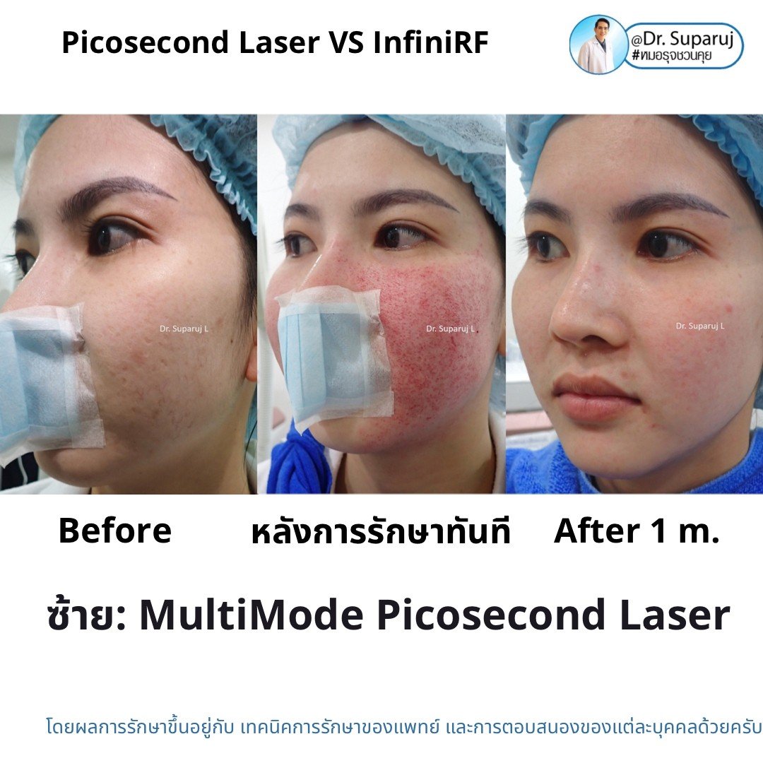 Update ผลการรักษาหลุมสิวด้วย Picosecond Laser VS InfiniRF Microneedle แตกต่างกันอย่างไร อันไหนมีประสิทธิภาพดีกว่า ? Update ผลการรักษาหลุมสิวด้วย Picosecond Laser VS InfiniRF Microneedle แตกต่างกันอย่างไร อันไหนมีประสิทธิภาพดีกว่า ?
