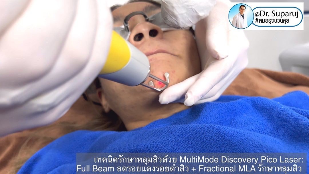 เทคนิครักษาหลุมสิวด้วย MultiMode Discovery Pico Laser: Full Beam ลดรอยแดงรอยดำสิว + Fractional MLA รักษาหลุมสิวครับ เทคนิครักษาหลุมสิวด้วย MultiMode Discovery Pico Laser: Full Beam ลดรอยแดงรอยดำสิว + Fractional MLA รักษาหลุมสิวครับ
