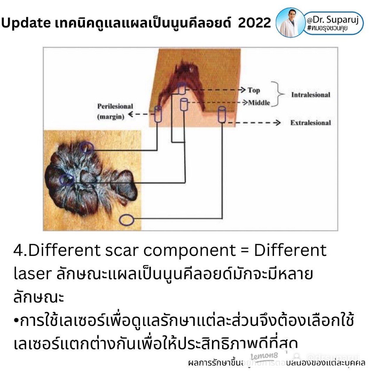 แผลเป็นนูนคีลอยคีลอยด์สามารถรักษาด้วยโดยวิธีผ่าตัดออกได้ไหม ?