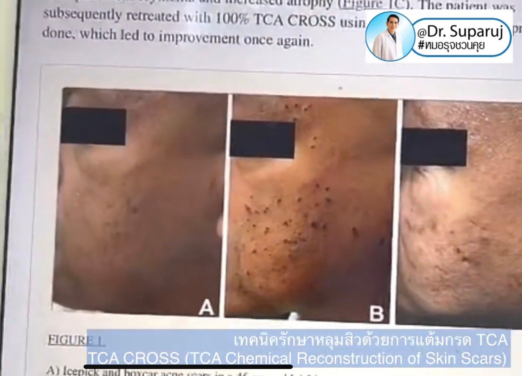 รักษาหลุมสิวด้วยการแต้มกรด TCA แล้วเกิดเป็นรอยดำ เกิดจากอะไรได้บ้าง? รักษาหลุมสิวด้วยการแต้มกรด TCA แล้วเกิดเป็นรอยดำ เกิดจากอะไรได้บ้าง?
