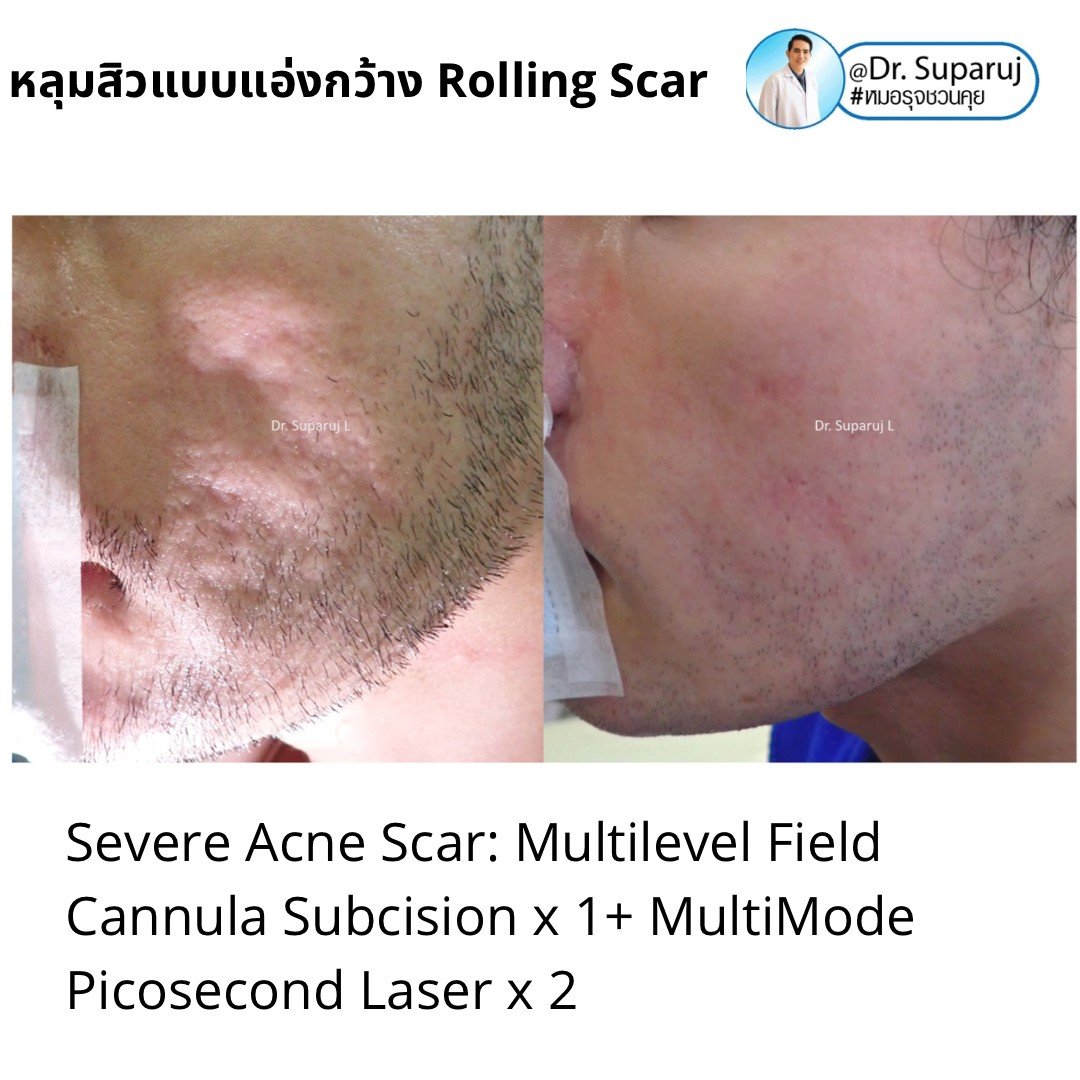 รักษาหลุมสิว ดูผลการรักษา ที่ระยะเวลาเท่าไหร่ดีที่สุด ? รักษาหลุมสิว ดูผลการรักษา ที่ระยะเวลาเท่าไหร่ดีที่สุด ?