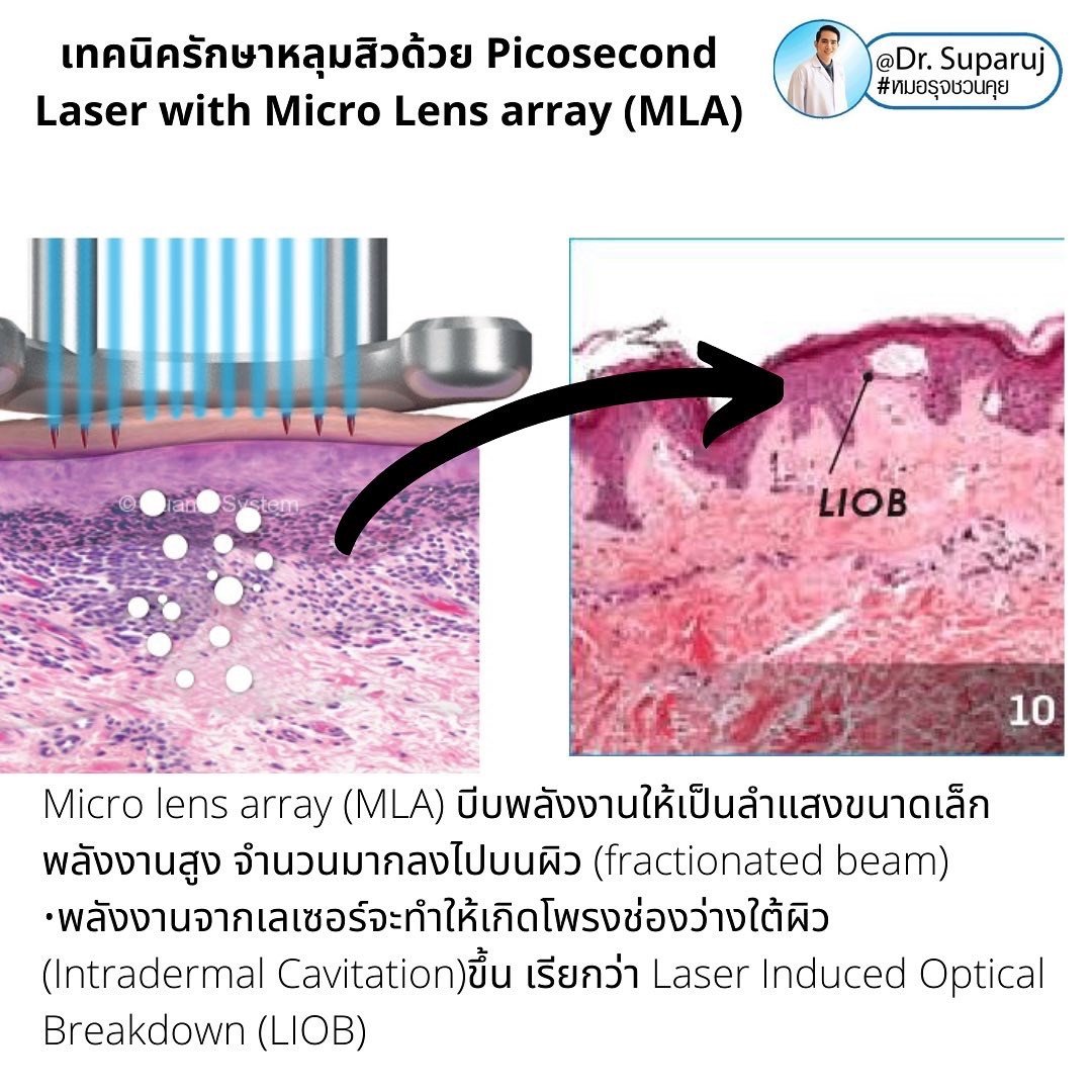 Update ผลการรักษาหลุมสิวด้วย Picosecond Laser VS InfiniRF Microneedle แตกต่างกันอย่างไร อันไหนมีประสิทธิภาพดีกว่า ? Update ผลการรักษาหลุมสิวด้วย Picosecond Laser VS InfiniRF Microneedle แตกต่างกันอย่างไร อันไหนมีประสิทธิภาพดีกว่า ?