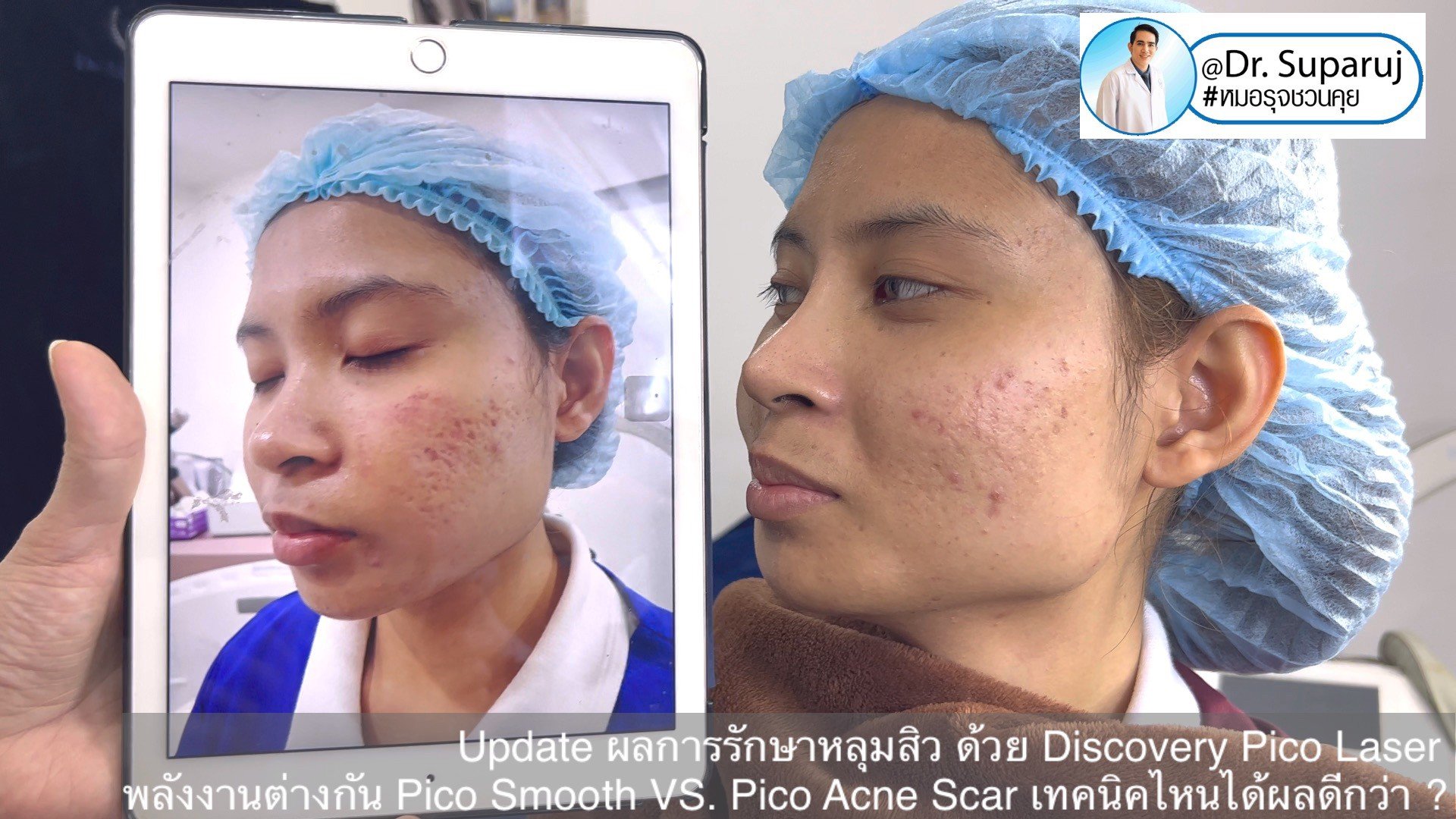  Update ผลการรักษาหลุมสิว ด้วย Discovery Pico Laser พลังงานต่างกัน Pico Smooth (Moderate Fluence) VS. Pico Acne Scar (High Fluence)เทคนิคไหนได้ผลดีกว่า ?