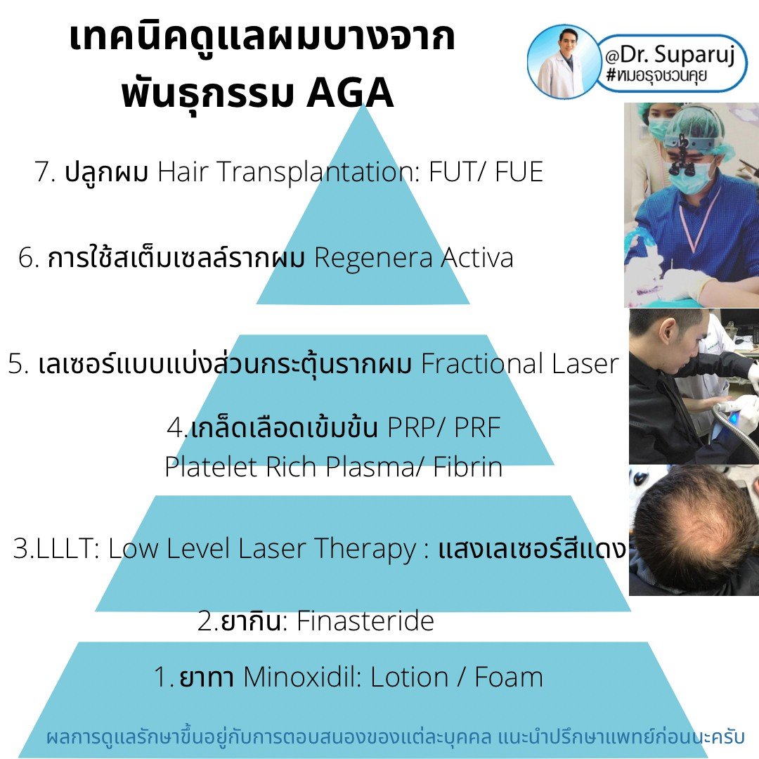 แนะนำเทคนิคดูแลรักษาผมร่วงผมบาง: ยารักษาผมร่วงผมบางมีอะไรบ้างและเลือกใช้อย่างไร? แนะนำเทคนิคดูแลรักษาผมร่วงผมบาง: ยารักษาผมร่วงผมบางมีอะไรบ้างและเลือกใช้อย่างไร?