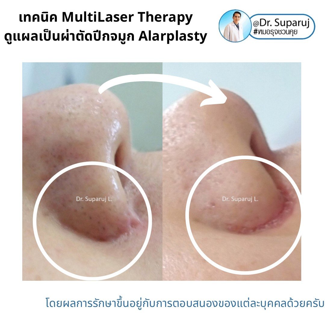 แนะนำเทคนิคดูแลแผลเป็นจากการผ่าตัด: ดูแลแผลเป็นนูนจากการผ่าตัดปีกจมูก Alarplasty ด้วยเทคนิค MultiLaser Therapy: Picosecond Laser + Gold Toning + Fractional Laser + Injection แนะนำเทคนิคดูแลแผลเป็นจากการผ่าตัด: ดูแลแผลเป็นนูนจากการผ่าตัดปีกจมูก Alarplasty ด้วยเทคนิค MultiLaser Therapy: Picosecond Laser + Gold Toning + Fractional Laser + Injection