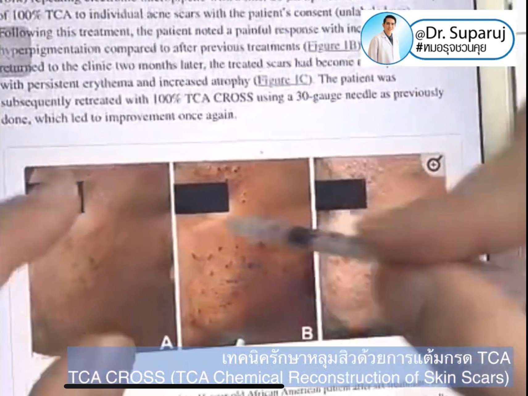 รักษาหลุมสิวด้วยการแต้มกรด TCA แล้วเกิดเป็นรอยดำ เกิดจากอะไรได้บ้าง? รักษาหลุมสิวด้วยการแต้มกรด TCA แล้วเกิดเป็นรอยดำ เกิดจากอะไรได้บ้าง?
