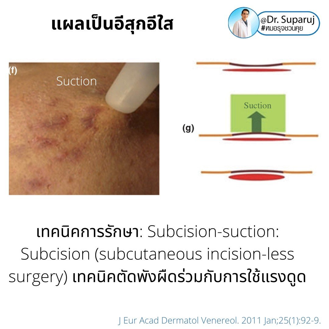 แผลเป็นยุบตัวจากอีสุกอีใส Chicken pox scars ดูแลได้อย่างไร ?