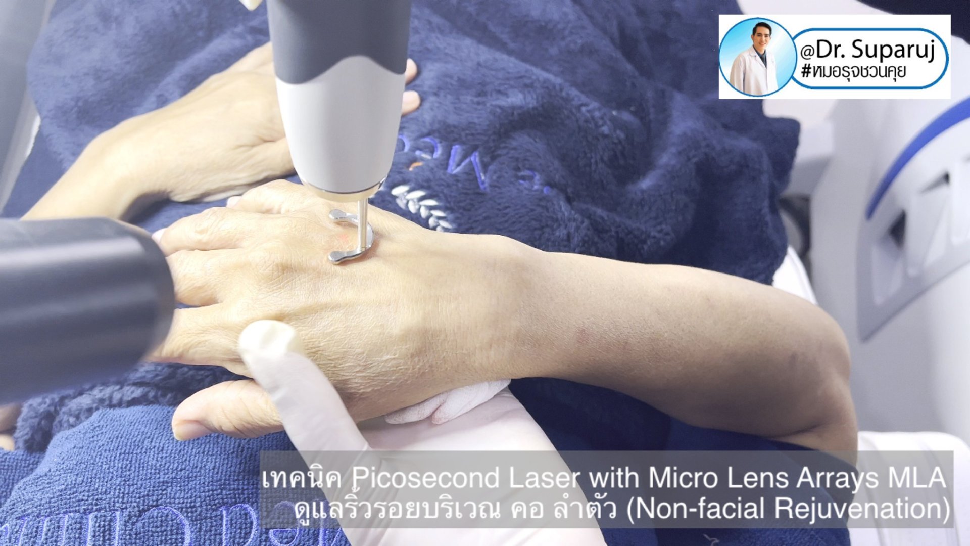 แนะนำ เทคนิคการใช้เลเซอร์ Picosecond Laser with Micro Lens Arrays MLA เพื่อดูแลริ้วรอยบริเวณ คอ ลำตัว (Non-facial rejuvenation) แนะนำ เทคนิคการใช้เลเซอร์ Picosecond Laser with Micro Lens Arrays MLA เพื่อดูแลริ้วรอยบริเวณ คอ ลำตัว (Non-facial rejuvenation)