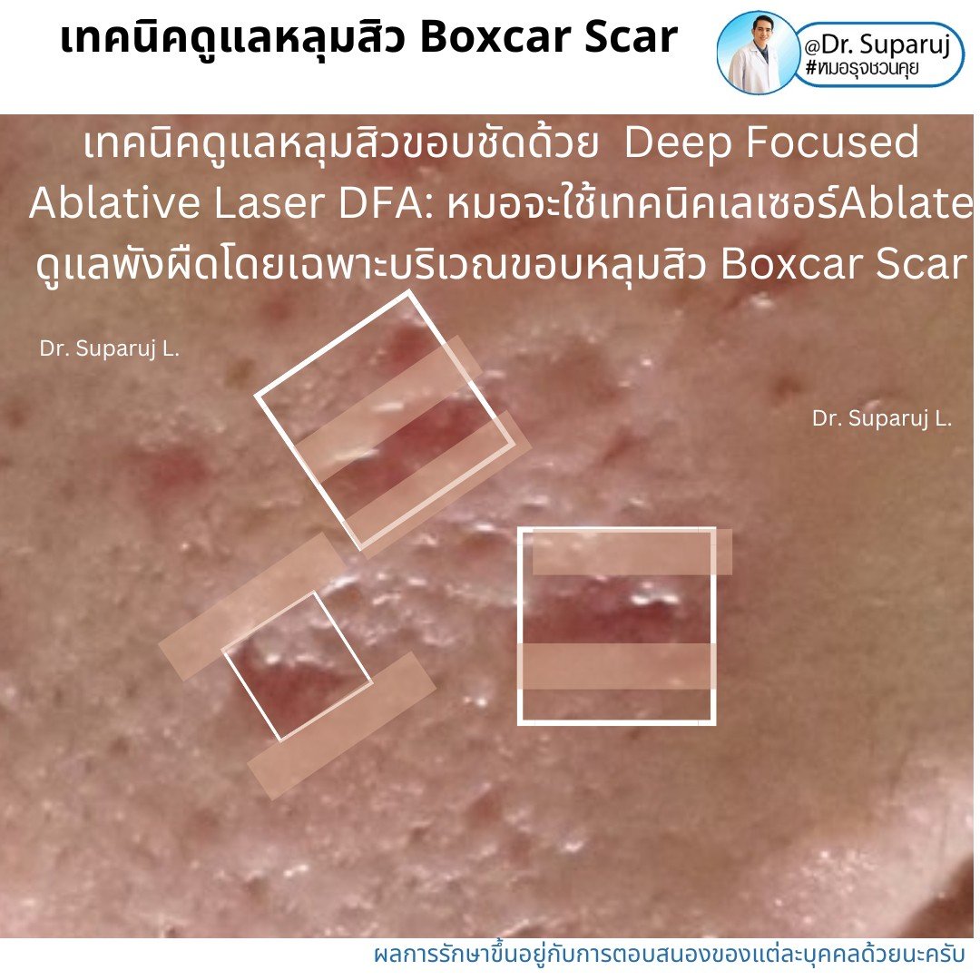 แนะนำเทคนิคดูแลหลุมสิว: เทคนิค Deep Focused Ablative Laser (DFA) ดูแลหลุมสิวลึกขอบชัดพังผืดหนา Boxcar Scar และหลุมสิวลักษณะเส้นยาว Linear scar แนะนำเทคนิคดูแลหลุมสิว: เทคนิค Deep Focused Ablative Laser (DFA) ดูแลหลุมสิวลึกขอบชัดพังผืดหนา Boxcar Scar และหลุมสิวลักษณะเส้นยาว Linear scar