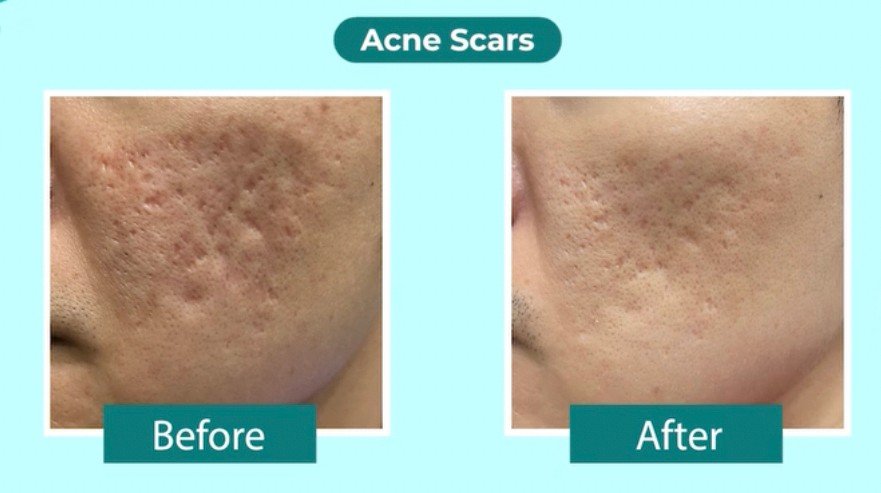 Rejuran Healer Polynucleotide Skin Booster ช่วยฟื้นฟูสร้างเซลล์ผิวใหม่ ดูแลหลุมสิว รูขุมขนกว้าง ริ้วรอย Rejuran Healer Polynucleotide Skin Booster ช่วยฟื้นฟูสร้างเซลล์ผิวใหม่ ดูแลหลุมสิว รูขุมขนกว้าง ริ้วรอย