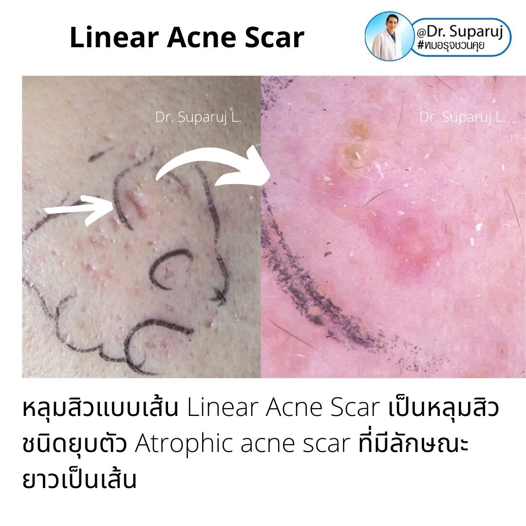  เทคนิคประเมินความรุนแรงพังผืดหลุมสิว Acne Scar Fibrosis Assessment : เทคนิคดึงยืดผิว Mannual Strechching (ง่ายๆ ประเมินได้ด้วยตัวเองครับ )