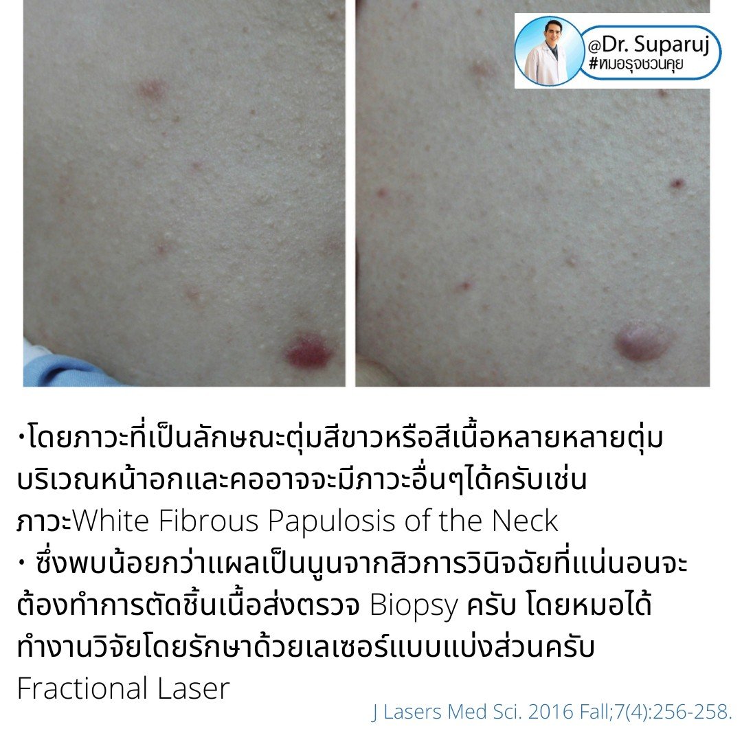 การรักษาเสริม: การรักษาเสริมด้วยหัตถการต่างๆ การรักษาเสริม: การรักษาเสริมด้วยหัตถการต่างๆ