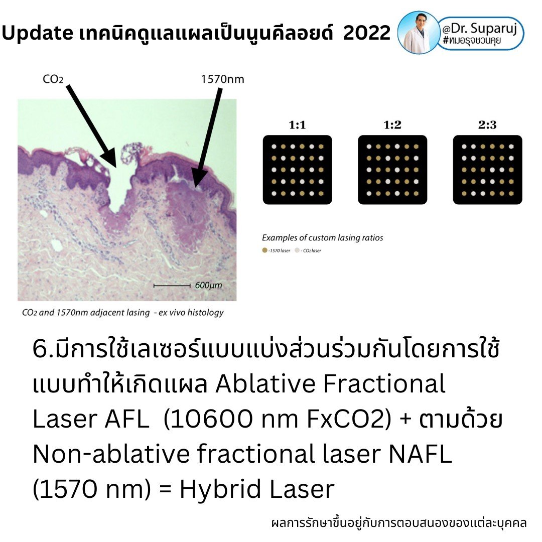 Update เทคนิคดูแลแผลเป็นนูนคีลอยด์ 2022