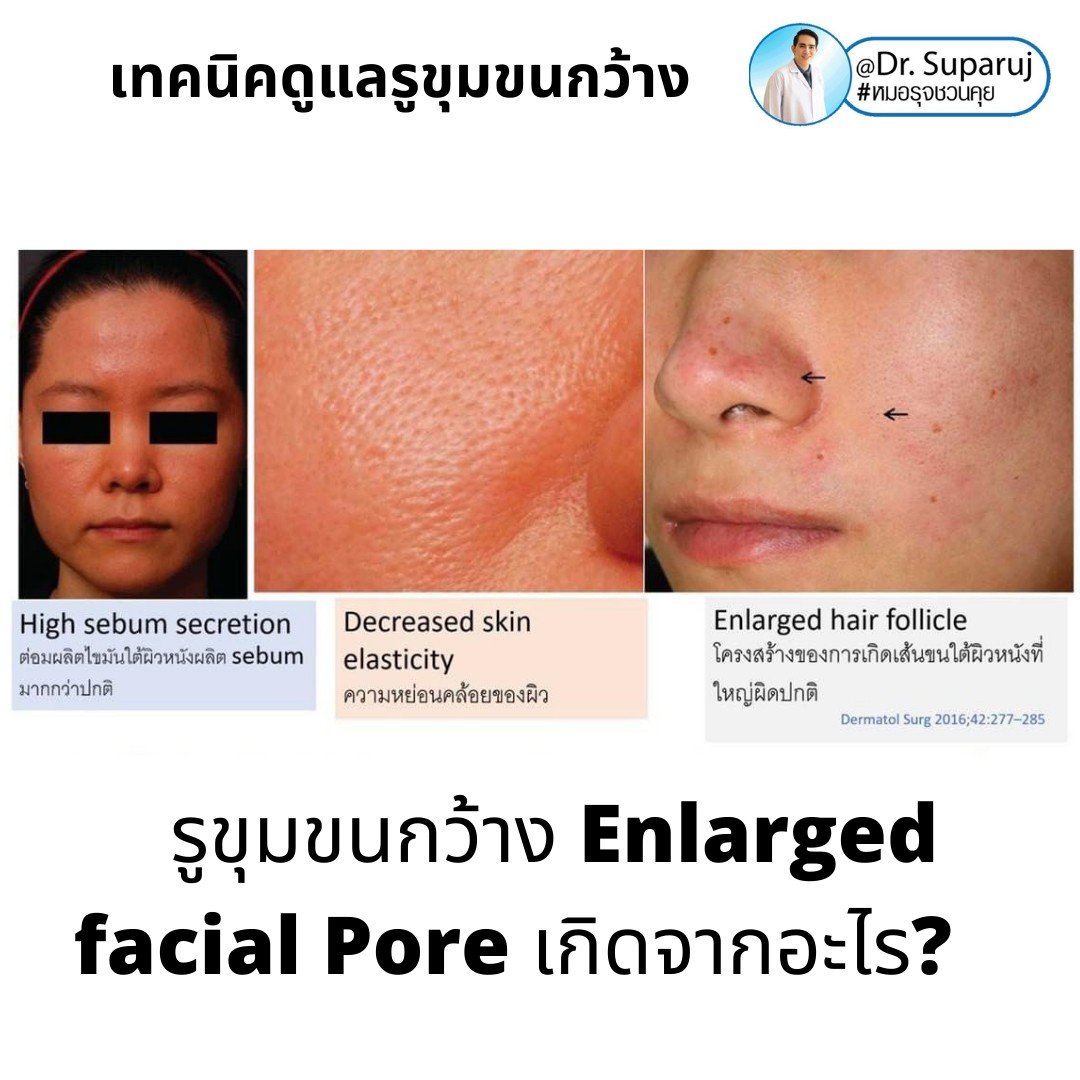 เทคนิควิเคราะห์ & รักษาขุมขนกว้าง Enlarged Facial Pore ด้วยกล้อส่องขยายพิเศษทางผิวหนัง Dermoscopy เทคนิควิเคราะห์ & รักษาขุมขนกว้าง Enlarged Facial Pore ด้วยกล้อส่องขยายพิเศษทางผิวหนัง Dermoscopy