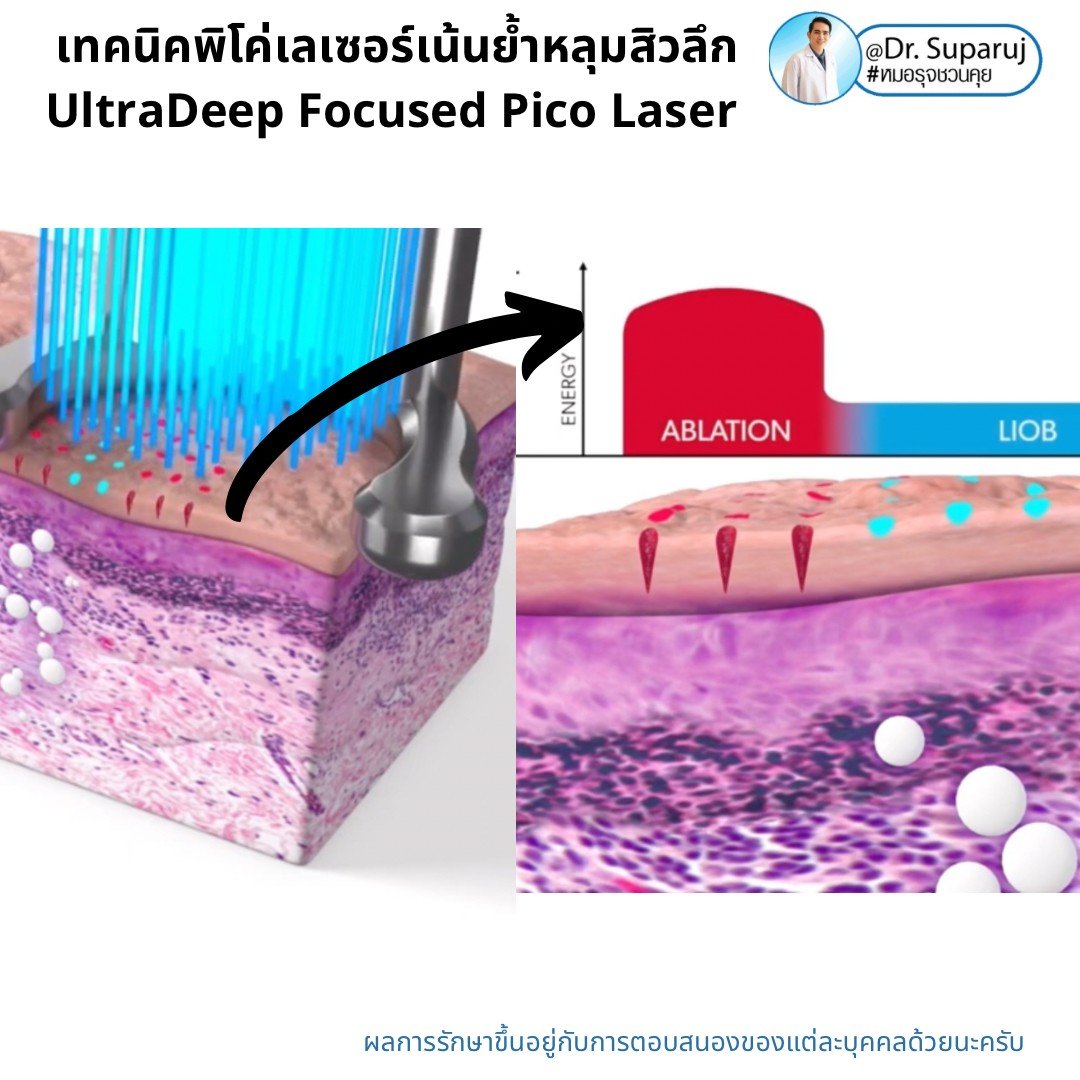 แนะนำเทคนิคดูแลหลุมสิว: เทคนิคพิโค่เลเซอร์เน้นย้ำหลุมสิวลึก UltraDeep Focused Picosecond Laser