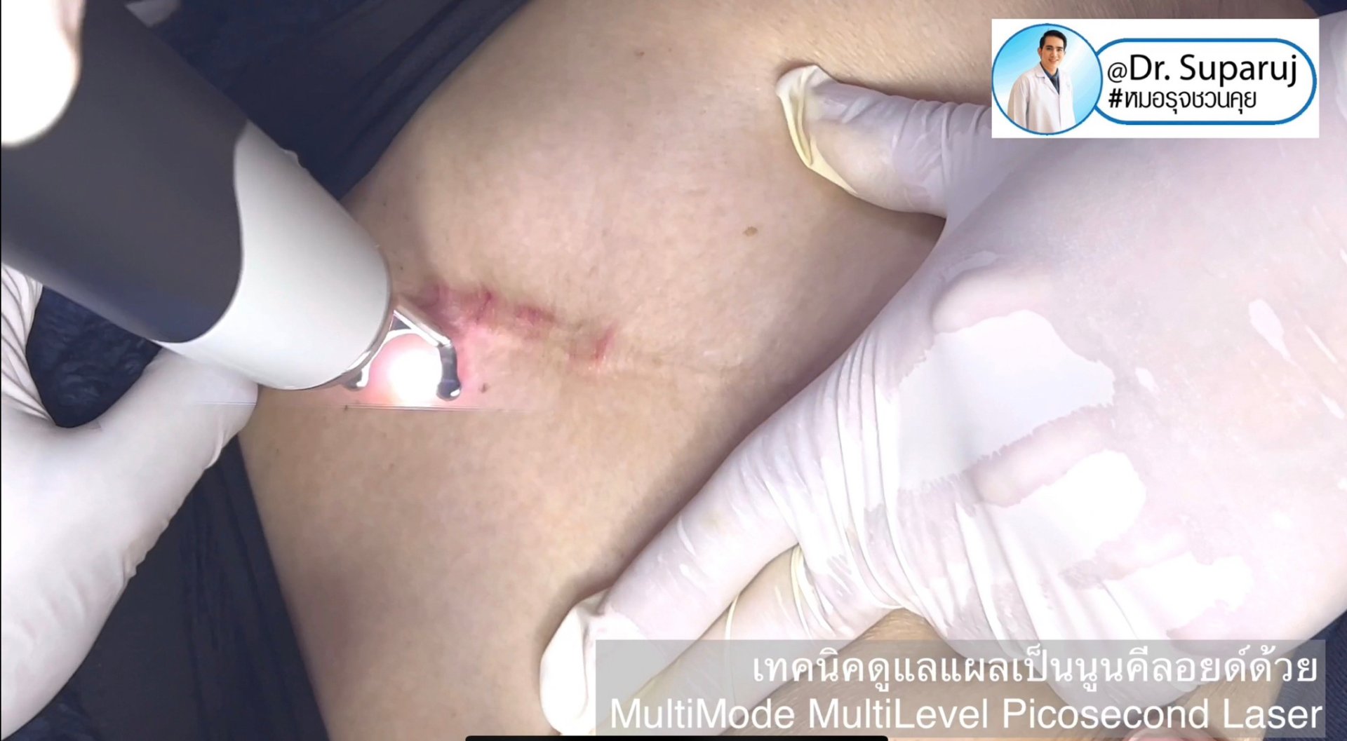 เทคนิคดูแลแผลเป็นด้วยเทคนิค MultiMode MultiLayer Discovery Picosecond Laser with Micro Lens Array MLA เทคนิคดูแลแผลเป็นด้วยเทคนิค MultiMode MultiLayer Discovery Picosecond Laser with Micro Lens Array MLA