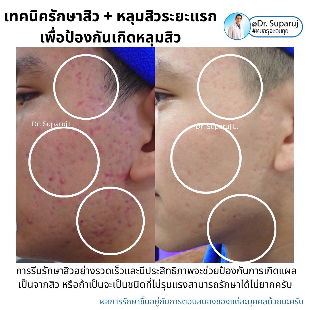 แนะนำเทคนิคดูแลรักษาสิวและหลุมสิว: ดูแลรอยแดงจากสิวและแผลเป็นยุบตัวจากสิว Acne + Macular acne erythema + Atrophic acne scar ดูแลด้วย Picosecond Laser + Healite + Medication