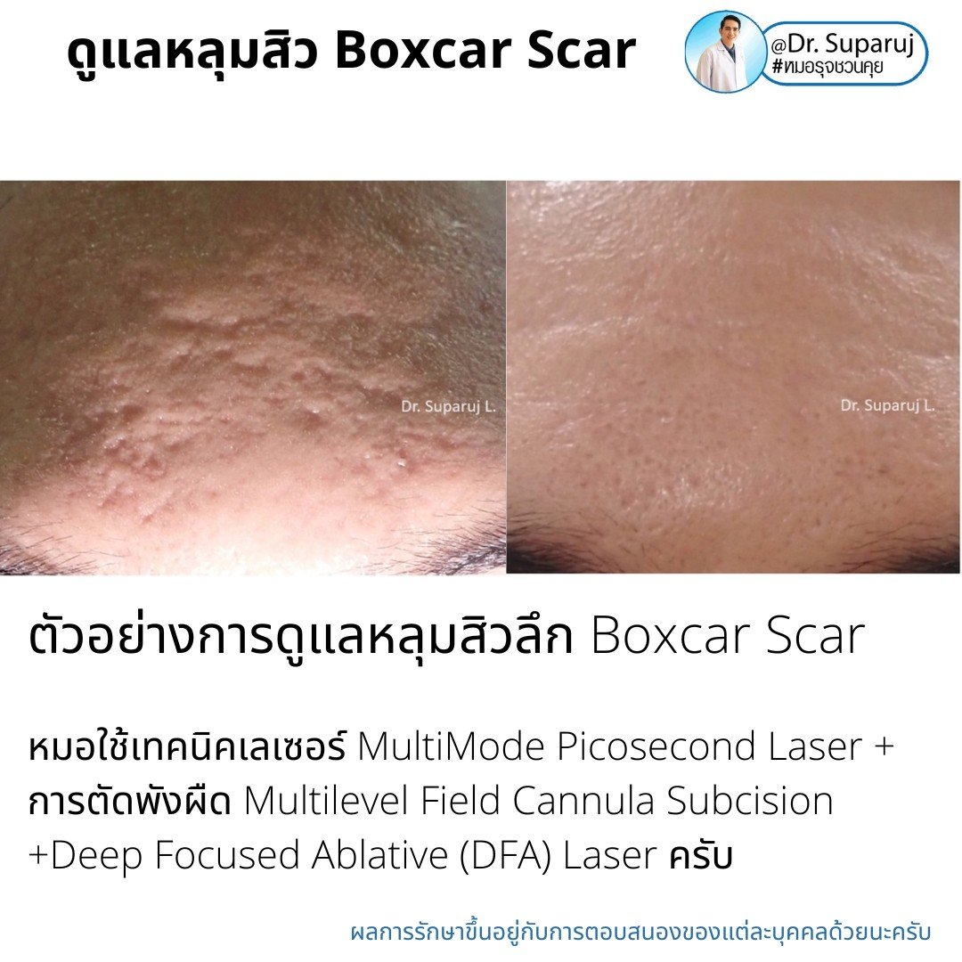 เทคนิคการดูแลหลุมสิว: ตัวอย่างการดูแลหลุมสิวแบบขอบชัดและแบบยุบตัวด้วยการใช้ Picosecond Laser + Perfusion Matrix Therapy เทคนิคการดูแลหลุมสิว: ตัวอย่างการดูแลหลุมสิวแบบขอบชัดและแบบยุบตัวด้วยการใช้ Picosecond Laser + Perfusion Matrix Therapy